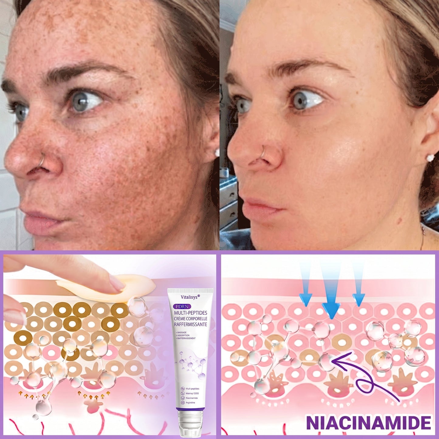 👑Boutique officielle✅ : Vitalisys® PDRN Crème Corps avec Roller ✨ – Anti-âge, hydratation, fermeté et régénération. Pour un teint unifié, traite acné, taches pigmentaires et verrues 🥰